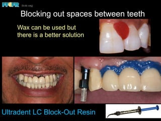 Blocking out spaces between teeth
Ultradent LC Block-Out Resin
Wax can be used but
there is a better solution
 