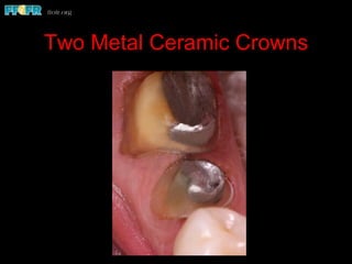 Two Metal Ceramic Crowns
 