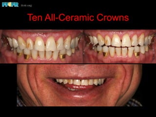 Ten All-Ceramic Crowns
 