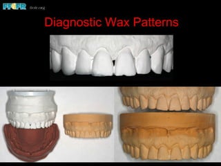 Diagnostic Wax Patterns
 