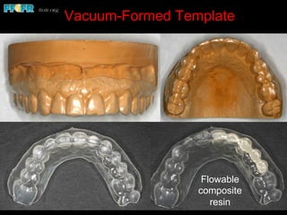 Vacuum-Formed Template
Flowable
composite
resin
 