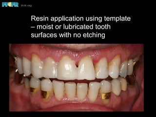 Resin application using template
– moist or lubricated tooth
surfaces with no etching
 