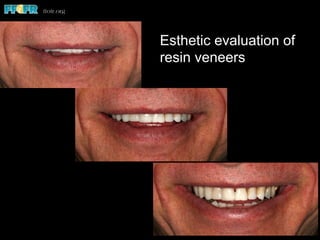 Esthetic evaluation of
resin veneers
 