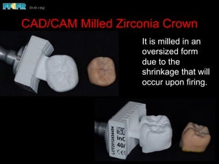CAD/CAM Milled Zirconia Crown
It is milled in an
oversized form
due to the
shrinkage that will
occur upon firing.
 