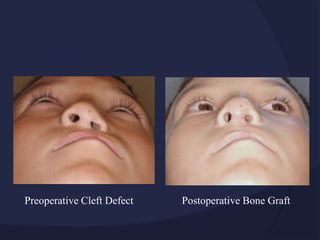 Preoperative Cleft Defect Postoperative Bone Graft
 