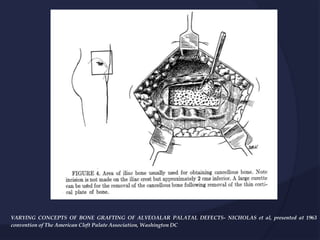 VARYING CONCEPTS OF BONE GRAFTING OF ALVEOALAR PALATAL DEFECTS- NICHOLAS et al, presented at 1963
convention of The American Cleft Palate Association, Washington DC
 