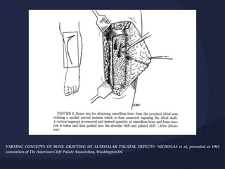 VARYING CONCEPTS OF BONE GRAFTING OF ALVEOALAR PALATAL DEFECTS- NICHOLAS et al, presented at 1963
convention of The American Cleft Palate Association, Washington DC
 