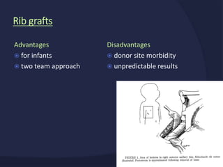 Disadvantages
 donor site morbidity
 unpredictable results
Advantages
 for infants
 two team approach
Rib grafts
 