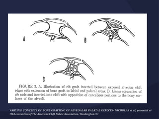 VARYING CONCEPTS OF BONE GRAFTING OF ALVEOALAR PALATAL DEFECTS- NICHOLAS et al, presented at
1963 convention of The American Cleft Palate Association, Washington DC
 