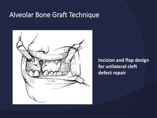 Alveolar Bone Graft Technique
Incision and flap design
for unilateral cleft
defect repair
 