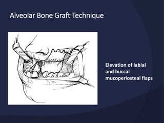 Alveolar Bone Graft Technique
Elevation of labial
and buccal
mucoperiosteal flaps
 