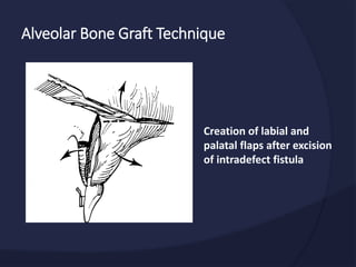 Alveolar Bone Graft Technique
Creation of labial and
palatal flaps after excision
of intradefect fistula
 