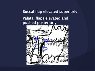 Buccal flap elevated superiorly
Palatal flaps elevated and
pushed posteriorly
 