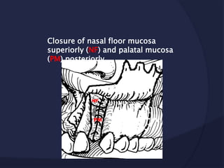 Closure of nasal floor mucosa
superiorly (NF) and palatal mucosa
(PM) posteriorly
NF
PM
 
