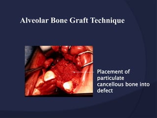 Placement of
particulate
cancellous bone into
defect
Alveolar Bone Graft Technique
 