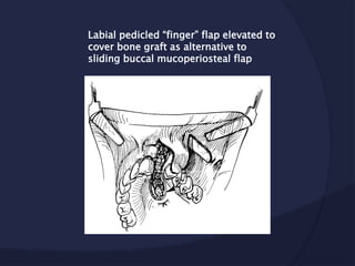 Labial pedicled “finger” flap elevated to
cover bone graft as alternative to
sliding buccal mucoperiosteal flap
 