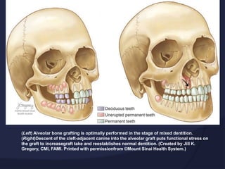  (Left) Alveolar bone grafting is optimally performed in the
stage of mixed dentition. (Right)
 Descent of the cleft-adjacent canine into the alveolar graft
puts functional stress on the graft to increase
 graft take and reestablishes normal dentition. (Created by
Jill K. Gregory, CMI, FAMI. Printed with permission
 from ©Mount Sinai Health System.)
(Left) Alveolar bone grafting is optimally performed in the stage of mixed dentition.
(Right)Descent of the cleft-adjacent canine into the alveolar graft puts functional stress on
the graft to increasegraft take and reestablishes normal dentition. (Created by Jill K.
Gregory, CMI, FAMI. Printed with permissionfrom ©Mount Sinai Health System.)
 