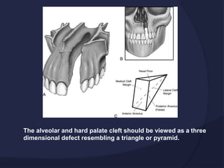 The alveolar and hard palate cleft should be viewed as a three
dimensional defect resembling a triangle or pyramid.
 