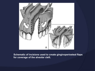 Schematic of incisions used to create gingivoperiosteal flaps
for coverage of the alveolar cleft.
 