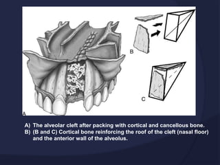 A) The alveolar cleft after packing with cortical and cancellous bone.
B) (B and C) Cortical bone reinforcing the roof of the cleft (nasal floor)
and the anterior wall of the alveolus.
 