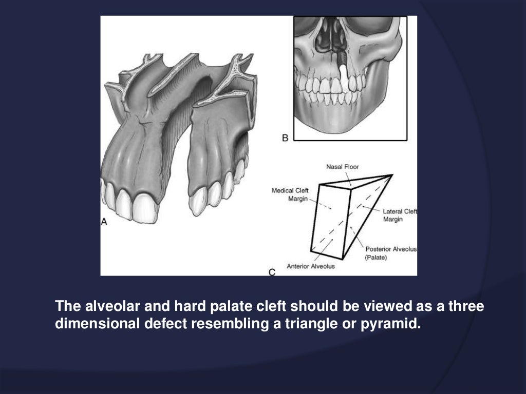 Secondary alveolar bone grafting