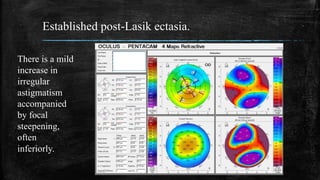 Established post-Lasik ectasia.
There is a mild
increase in
irregular
astigmatism
accompanied
by focal
steepening,
often
inferiorly.
 