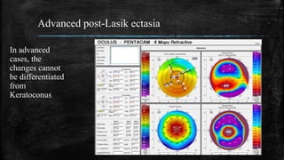 Advanced post-Lasik ectasia
In advanced
cases, the
changes cannot
be differentiated
from
Keratoconus
 