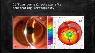 Diffuse corneal ectasia after
penetrating keratoplasty
 