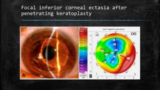 Focal inferior corneal ectasia after
penetrating keratoplasty
 