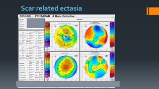 Scar related ectasia
 