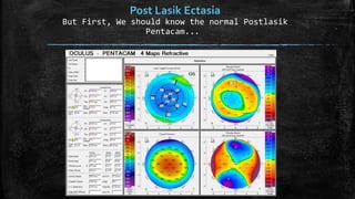 Post Lasik Ectasia
But First, We should know the normal Postlasik
Pentacam...
 