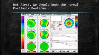But First, We should know the normal
Postlasik Pentacam...
 