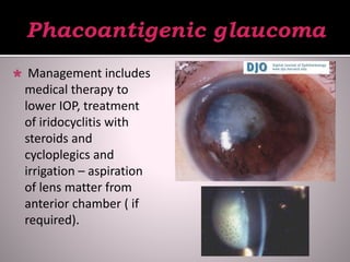  Management includes
medical therapy to
lower IOP, treatment
of iridocyclitis with
steroids and
cycloplegics and
irrigation – aspiration
of lens matter from
anterior chamber ( if
required).
 