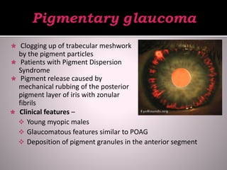  Clogging up of trabecular meshwork
by the pigment particles
 Patients with Pigment Dispersion
Syndrome
 Pigment release caused by
mechanical rubbing of the posterior
pigment layer of iris with zonular
fibrils
 Clinical features –
 Young myopic males
 Glaucomatous features similar to POAG
 Deposition of pigment granules in the anterior segment
 