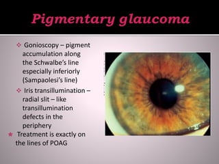  Gonioscopy – pigment
accumulation along
the Schwalbe’s line
especially inferiorly
(Sampaolesi’s line)
 Iris transillumination –
radial slit – like
transillumination
defects in the
periphery
 Treatment is exactly on
the lines of POAG
 