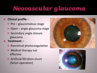  Clinical profile –
 Pre – glaucomatous stage
 Open – angle glaucoma stage
 Secondary angle closure
glaucoma
 Treatment –
 Panretinal photocoagulation
 Medical therapy not
effective
 Artificial filtration shunt
(Seton operation)
 