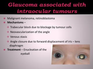  Malignant melanoma, retinoblastoma
 Mechanisms –
 Trabecular block due to blockage by tumour cells
 Neovascularization of the angle
 Venous stasis
 Angle closure due to forward displacement of iris – lens
diaphragm
 Treatment – Enucleation of the
eyeball
 
