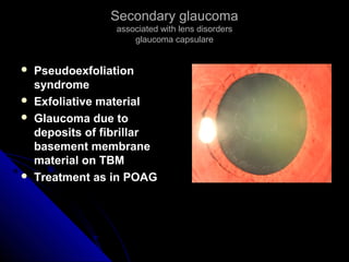 Secondary glaucomaSecondary glaucoma
associated with lens disordersassociated with lens disorders
glaucoma capsulareglaucoma capsulare
 PseudoexfoliationPseudoexfoliation
syndromesyndrome
 Exfoliative materialExfoliative material
 Glaucoma due toGlaucoma due to
deposits of fibrillardeposits of fibrillar
basement membranebasement membrane
material on TBMmaterial on TBM
 Treatment as in POAGTreatment as in POAG
 