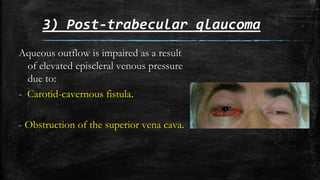 3) Post-trabecular glaucoma
Aqueous outflow is impaired as a result
of elevated episcleral venous pressure
due to:
- Carotid-cavernous fistula.
- Obstruction of the superior vena cava.
 
