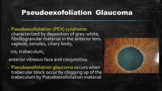 Pseudoexofoliation Glaucoma
- Pseudoexofoliation (PEX) syndrome:
characterized by deposition of grey-white,
fibrillogranular material in the anterior lens
capsule, zonules, ciliary body,
iris, trabeculum,
anterior vitreous face and conjunctiva.
- Pseudoexofoliation glaucoma occurs when
trabecular block occur by clogging up of the
trabeculum by Pseudoexofoliation material
 