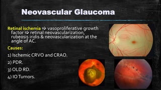 Neovascular Glaucoma
Retinal ischemia  vasoproliferative growth
factor  retinal neovascularization,
rubeosis iridis & neovascularization at the
angle of AC.
Causes:
1) Ischemic CRVO and CRAO.
2) PDR.
3) OLD RD.
4) IOTumors.
 