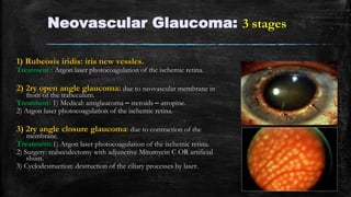Neovascular Glaucoma: 3 stages
1) Rubeosis iridis: iris new vessles.
Treatment : Argon laser photocoagulation of the ischemic retina.
2) 2ry open angle glaucoma: due to neovascular membrane in
front of the trabeculum.
Treatment: 1) Medical: antiglaucoma – steroids – atropine.
2) Argon laser photocoagulation of the ischemic retina.
3) 2ry angle closure glaucoma: due to contraction of the
membrane.
Treatment:1) Argon laser photocoagulation of the ischemic retina.
2) Surgery: trabeculectomy with adjunctive Mitomycin C OR artificial
shunt.
3) Cyclodestruction: destruction of the ciliary processes by laser.
 