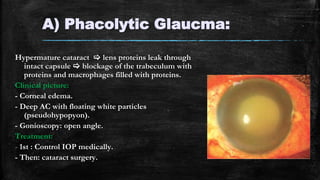 A) Phacolytic Glaucma:
Hypermature cataract  lens proteins leak through
intact capsule  blockage of the trabeculum with
proteins and macrophages filled with proteins.
Clinical picture:
- Corneal edema.
- Deep AC with floating white particles
(pseudohypopyon).
- Gonioscopy: open angle.
Treatment:
- 1st : Control IOP medically.
- Then: cataract surgery.
 