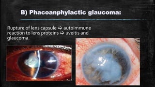 B) Phacoanphylactic glaucoma:
Rupture of lens capsule  autoimmune
reaction to lens proteins  uveitis and
glaucoma.
 