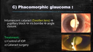C) Phacomorphic glaucoma :
Intumescent cataract (Swollen lens) 
pupillary block  iris bombe  angle
closure.
Treatment:
1) Control of IOP.
2) Cataract surgery.
 