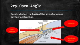 2ry Open Angle
Subdivided on the basis of the site of aqueous
outflow obstruction.
Pre-trabecular
glaucoma
Trabecular
Post-
trabecular
 