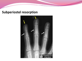 Subperiostel resorption
 