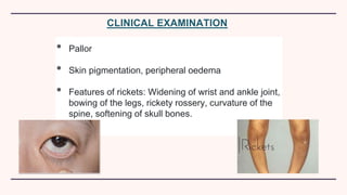 • Pallor
• Skin pigmentation, peripheral oedema
• Features of rickets: Widening of wrist and ankle joint,
bowing of the legs, rickety rossery, curvature of the
spine, softening of skull bones.
CLINICAL EXAMINATION
 