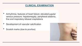 • Arrhythmia, features of heart failure: elevated jugular
venous pressure. hepatomegaly, peripheral oedema,
fine end inspiratory bibasal crepitations
• Development of vascular calcification
• Scratch marks (due to pruritus)
CLINICAL EXAMINATION
 
