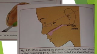 Fluid wax technique
 Done immediately after making the wash impression and before pouring the
master cast.
 Zinc oxide eugenol and impression plaster are suitable impression materials
for this technique as fluid wax adheres well to them.
 The anterior and posterior vibrating lines are marked . these lines are marked
in the patients mouth immediately after making wash impression.
 The marking are transferred to the secondary or wash impression by reseating
the impression in the mouth.
 The wash impression is painted with fluid wax.
 